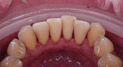 After professional dental cleaning showing reduced build-up and fresher appearance